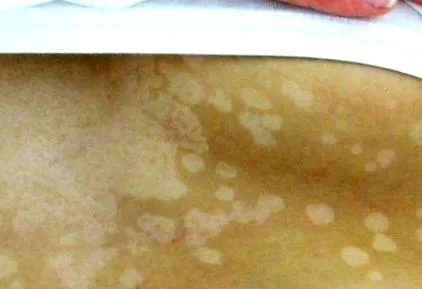 piele