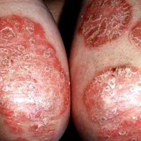 Eczema este detoxifiere