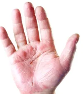 dermatita