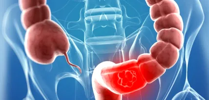 colorectalis