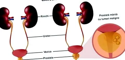 prostatectomia