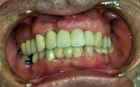 implanturilor dentare