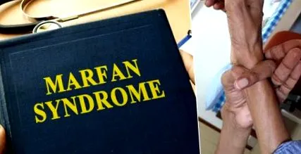 sindromul sindromul