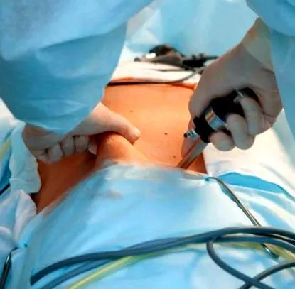 laparoscopic laparoscopic