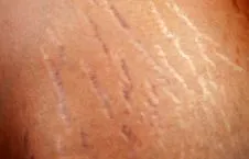 striae creșterea rapidă