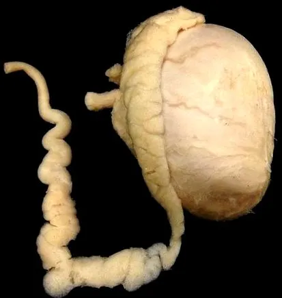 varicocele