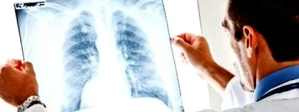este foarte PNEUMONIE INFECȚIOASĂ