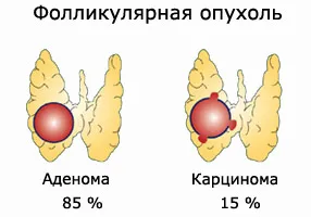 Pajzsmirigy adenoma tünetek, diagnózis, kezelés