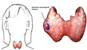 Pajzsmirigy adenoma tünetek, diagnózis, kezelés
