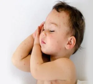 Allergia bőr vörös foltok a gyermek - ez mit jelent (piros) Allergia bőr vörös foltok a gyermek - ez mit jelent