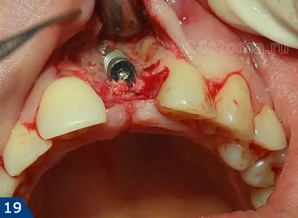 Alpha Bio implantátum - alfa-bio Izrael véleménye és az ár 2017 előnyök