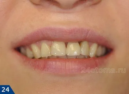 Alpha Bio implantátum - alfa-bio Izrael, értékelések és az ár 2017 előnyeit