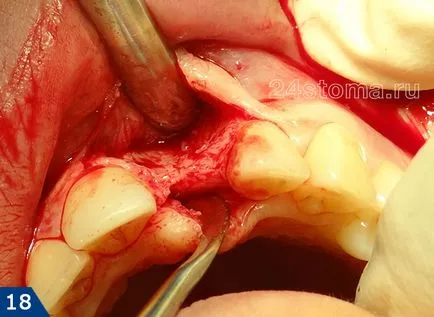 Alpha Bio implantátum - alfa-bio Izrael véleménye és az ár 2017 előnyök