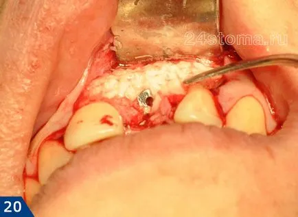 Alpha Bio implantátum - alfa-bio Izrael, értékelések és az ár 2017 előnyeit