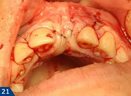 Alpha Bio implantátum - alfa-bio Izrael véleménye és az ár 2017 előnyök