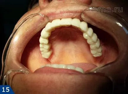 Alpha Bio implantátum - alfa-bio Izrael véleménye és az ár 2017 előnyök