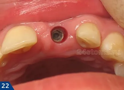 Alpha Bio implantátum - alfa-bio Izrael véleménye és az ár 2017 előnyök