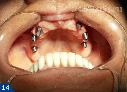 Alpha Bio implantátum - alfa-bio Izrael véleménye és az ár 2017 előnyök