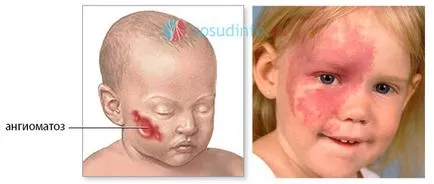 Angiomatosis, Sturge-Weber-szindróma (Sturge-Weber) fajok, a tünetek, a kezelés (szindróma) Angiomatosis, Sturge-Weber-szindróma (Sturge-Weber) típusok, a tünetek, a kezelés