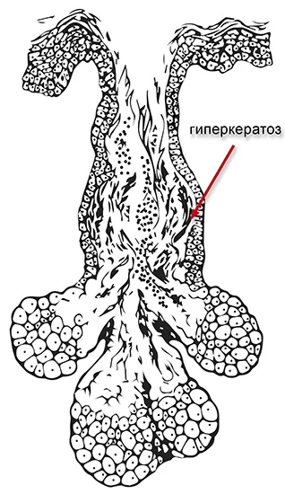 A benzoil-peroxid - akne választandó gyógyszer
