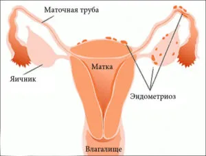 A veszélyesebb ciszták a női petefészekben részletesen a következmények