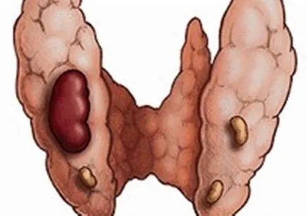Mi a pajzsmirigy adenoma és mik a tünetek (adenoma a pajzsmirigy) Mi a pajzsmirigy adenoma és mik a tünetek