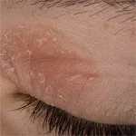 Photo dermatitisz gyermek, felnőtt, láb, arc
