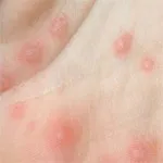 Photo dermatitisz gyermek, felnőtt, láb, arc