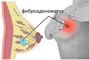Diffúz fibroadenomatosis mell, hogy ez, amit a korai tünetei és okai (fibroadenomatosis) Diffúz fibroadenomatosis mell, hogy ez, amit a korai tünetei és okai