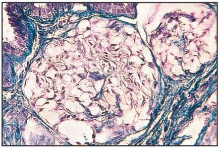 Diffúz fibroadenomatosis emlő okára és kezelésére (tej) Diffúz fibroadenomatosis mell okok és a kezelés