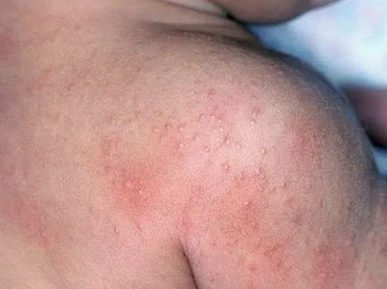 Dermatitis (fotók) - Tünetek és kezelés Felnőttek (fotó) Dermatitis (fotók) - Tünetek és kezelés Felnőttek