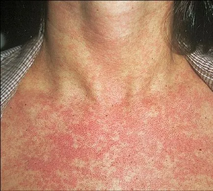 Dermatitis (fotók) - Tünetek és kezelés Felnőttek (kezelés) Dermatitis (fotók) - Tünetek és kezelés Felnőttek
