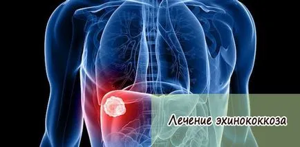 Echinococcus és hydatid betegség kezelésére gyermekeknél és felnőtteknél