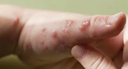 Herpes kézen okok, tünetek (fotó), hogyan lehet megszabadulni