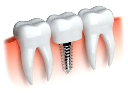 orális implantológia