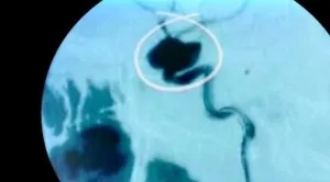 Az iszkémiás stroke-ot és a vérzéses