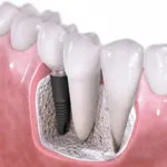 Izraeli implantátumok alfa - bio - előnyök és hátrányok, ár, értékelés (implantátumok) Izraeli implantátumok alfa - bio - előnyök és hátrányok, ár, vélemények