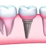 Izraeli implantátumok alfa - bio - előnyök és hátrányok, ár, értékelés (izraeli) Izraeli implantátumok alfa - bio - előnyök és hátrányok, ár, vélemények