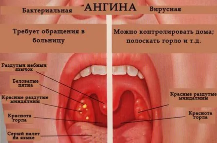 Hogyan lehet gyorsan gyógyítani a torokfájás egy gyermek vagy felnőtt a home (hogyan kell kezelni gennyes mandulagyulladás otthon) Hogyan lehet gyorsan gyógyítani a torokfájás egy gyermek vagy felnőtt a hazai