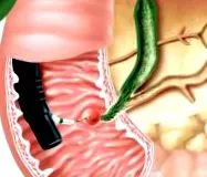 ercp