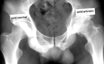 csípő osteoarthritis
