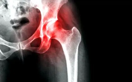 csípő osteoarthritis