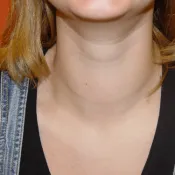 Kolloid pajzsmirigy csomópont - mi ez (pajzsmirigy) Kolloid pajzsmirigy csomópont - mi ez