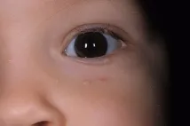 Molluscum contagiosum gyermekeknél (fotó)