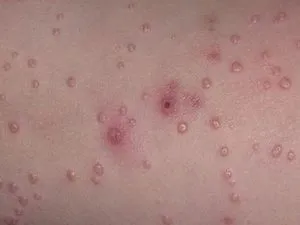 Molluscum contagiosum az arcon, hogy megszabaduljon a kozmetikai hibák, és nem kap depressziós (arc) Molluscum contagiosum az arcon, hogy megszabaduljon a kozmetikai hibák, és nem kap depressziós