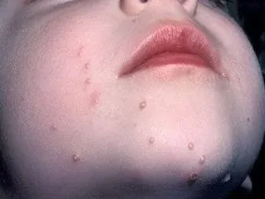 Molluscum contagiosum az arcon, hogy megszabaduljon a kozmetikai hibák, és nem kap depressziós (kagyló) Molluscum contagiosum az arcon, hogy megszabaduljon a kozmetikai hibák, és nem kap depressziós