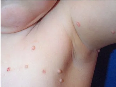 Molluscum contagiosum gyermekeknél (fotó)