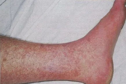 A szúnyogok Thaiföldön bármely betegség átment őr (szúnyog) A szúnyogok Thaiföldön amelyek hordozhatják a betegségeket, hogyan védheti meg magát
