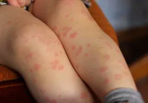 Vörös foltok a testen a gyermek a fotó a leírás a tünetek a betegségek (volt foltok a test) Vörös foltok a testen a baba fotó egy leírást a tünetek a betegségek