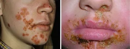 Staphylococcus-fertőzések kezelésére